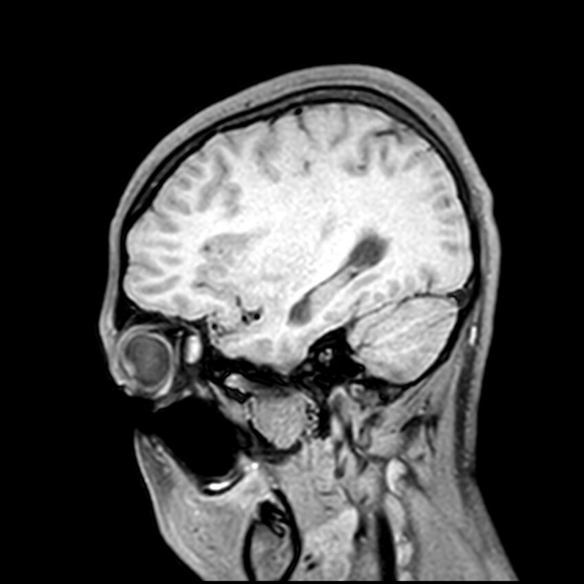 Central neurocytoma (Radiopaedia 79320-92380 Sagittal T1 75).jpg
