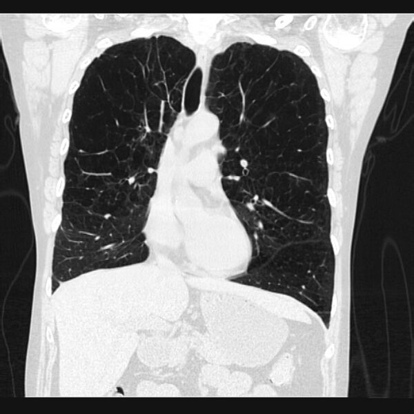 File:Centrilobular pulmonary emphysema (Radiopaedia 24495-24789 Coronal lung window 31).jpg