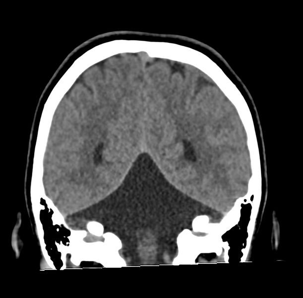 File:Cerebellar agenesis (Radiopaedia 30203-30817 Coronal non-contrast 33).jpg