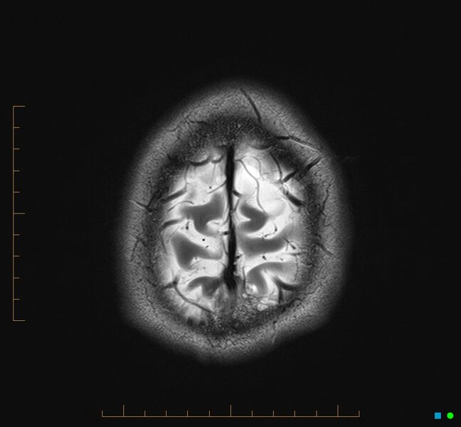 File:Cerebellar gangliocytoma (Radiopaedia 65377-74422 Axial T2 37).jpg