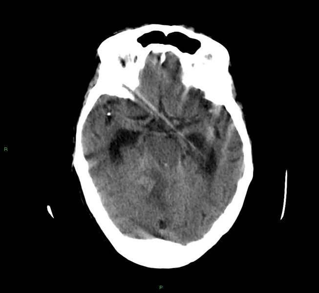 File:Cerebellar hemorrhage (Radiopaedia 58792-66026 Axial non-contrast 32).jpg