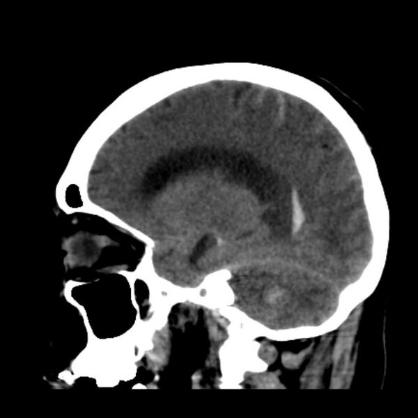 File:Cerebellar hemorrhage causing obstructive hydrocephalus (Radiopaedia 33989-35207 B 18).jpg