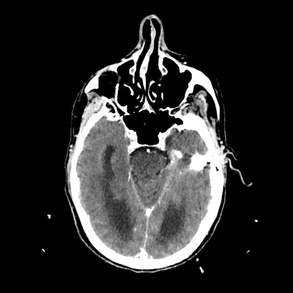 File:Cerebellar metastasis - lung tumor (Radiopaedia 69317-79145 Axial with contrast 15).jpg