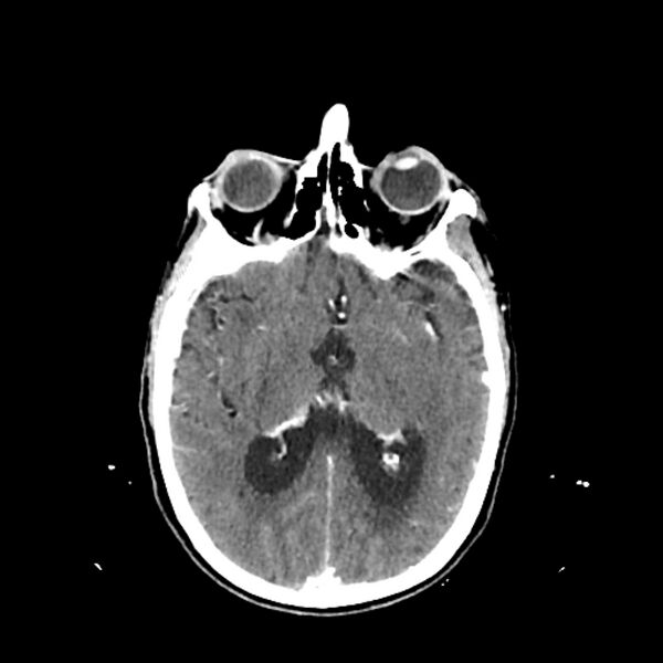 File:Cerebellar metastasis - lung tumor (Radiopaedia 69317-79145 Axial with contrast 21).jpg