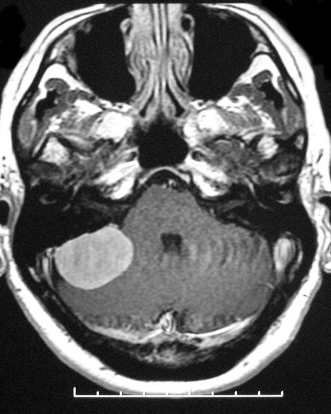 File:Cerebellopontine angle meningioma (Radiopaedia 2597-6293 Axial T1 C+ 1).jpg