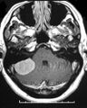 Cerebellopontine angle meningioma (Radiopaedia 2597-6293 Axial T1 C+ 1).jpg