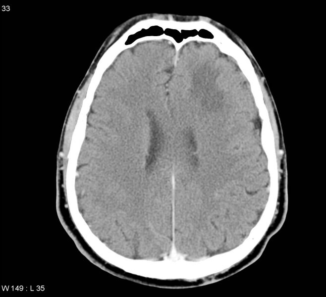 File:Cerebral abscess (Radiopaedia 5150-6933 Axial C+ delayed 2).jpg