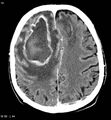 Cerebral abscesses secondary to contusions (Radiopaedia 5201-6967 Axial C+ delayed 5).jpg