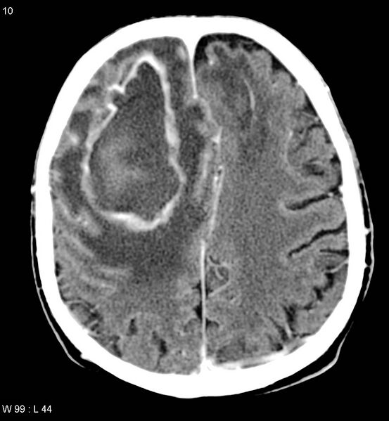File:Cerebral abscesses secondary to contusions (Radiopaedia 5201-6967 Axial C+ delayed 5).jpg