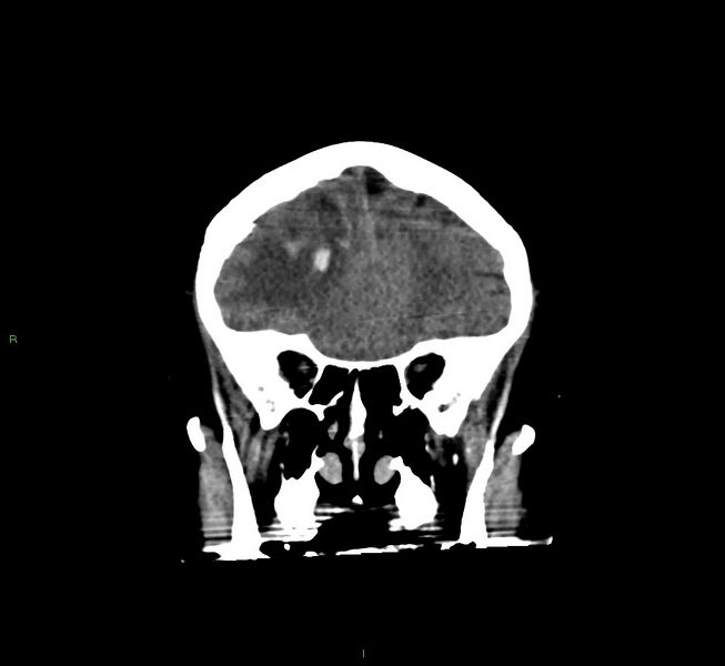 File:Cerebral amyloid angiopathy-associated lobar intracerebral hemorrhage (Radiopaedia 58560-65723 Coronal non-contrast 52).jpg