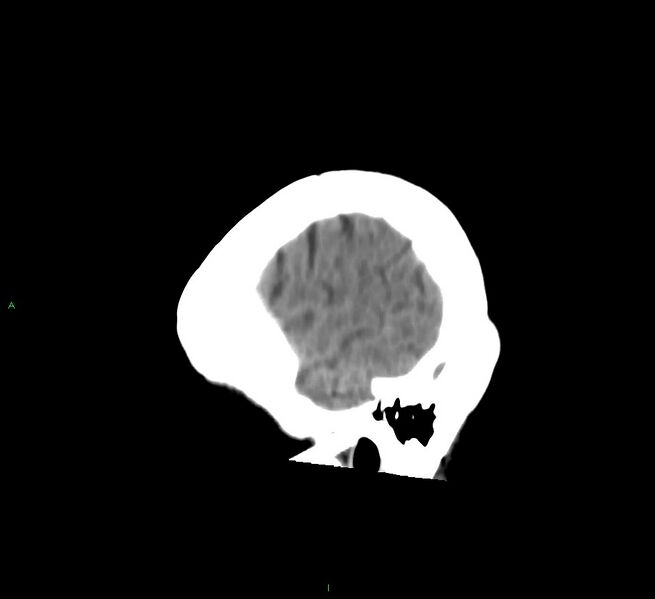 File:Cerebral amyloid angiopathy-associated lobar intracerebral hemorrhage (Radiopaedia 58754-65975 C 6).jpg