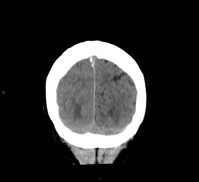 File:Cerebral amyloid angiopathy-associated lobar intracerebral hemorrhage (Radiopaedia 58756-65977 Coronal non-contrast 13).jpg
