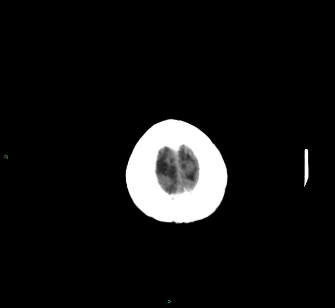 File:Cerebral amyloid angiopathy-associated lobar intracerebral hemorrhage (Radiopaedia 58757-65978 Axial non-contrast 5).jpg