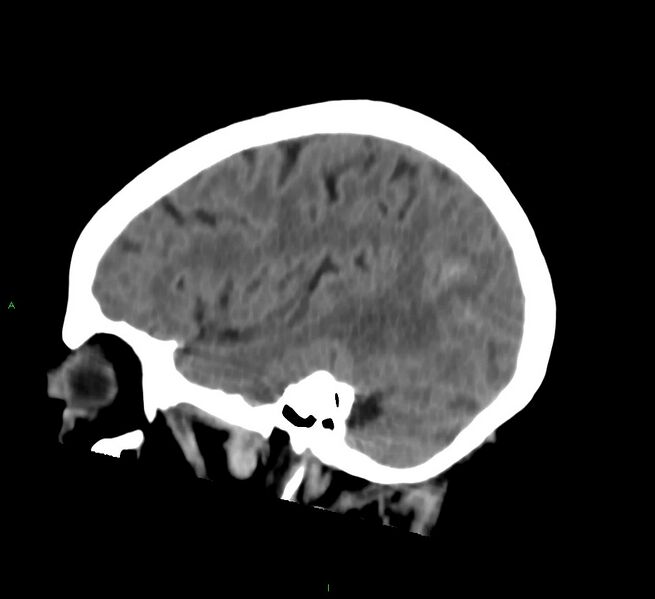 File:Cerebral amyloid angiopathy-associated lobar intracerebral hemorrhage (Radiopaedia 58757-65978 C 40).jpg