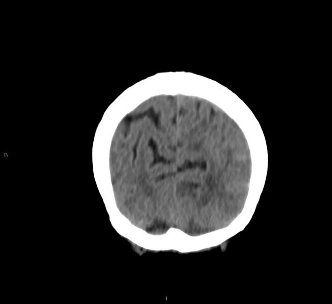 File:Cerebral amyloid angiopathy-associated lobar intracerebral hemorrhage (Radiopaedia 58757-65978 Coronal non-contrast 14).jpg