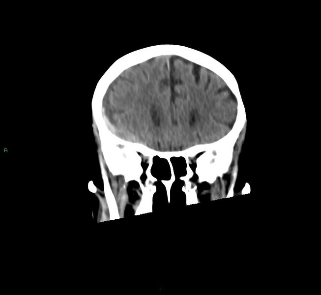 File:Cerebral amyloid angiopathy-associated lobar intracerebral hemorrhage (Radiopaedia 58758-65980 Coronal non-contrast 46).jpg