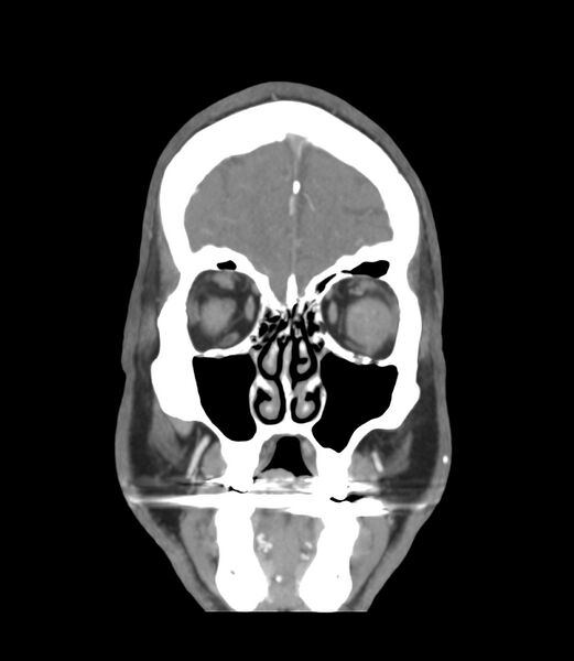 File:Cerebral dural venous sinus thrombosis (Radiopaedia 86514-102576 B 4).jpg