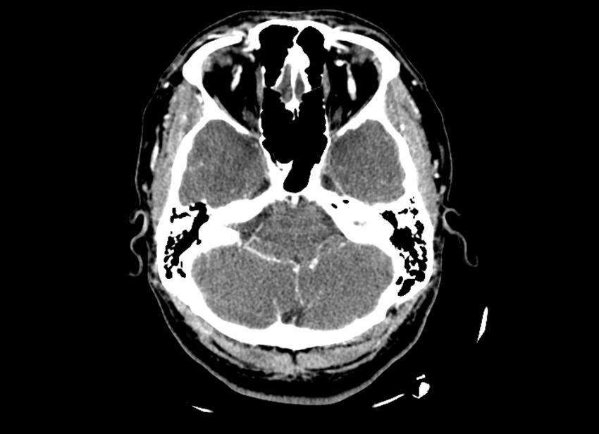 Cerebral edema (Radiopaedia 82519-96661 B 45).jpg
