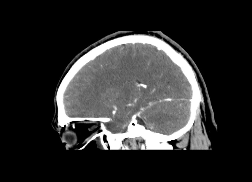 Cerebral edema (Radiopaedia 82519-96661 D 35).jpg