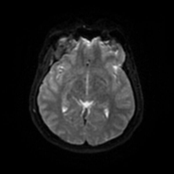 File:Cerebral fat embolism (Radiopaedia 37510-39363 Axial DWI 36).jpg