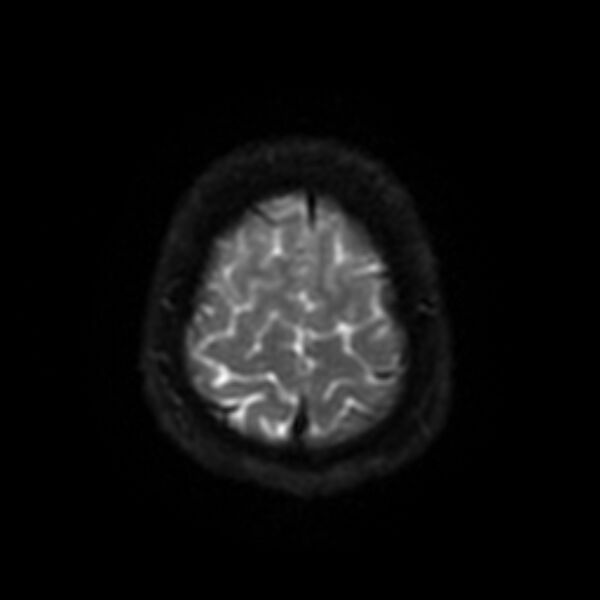 File:Cerebral fat embolism (Radiopaedia 37510-39363 Axial DWI 46).jpg