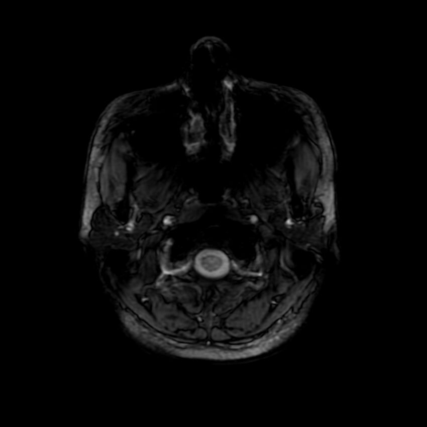 Cerebral paragonimiasis (Radiopaedia 73473-84238 Axial SWI 2).jpg