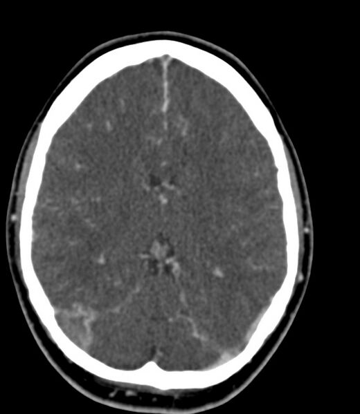 File:Cerebral venous sinus thrombosis (Radiopaedia 59224-66646 Axial C+ delayed 27).jpg