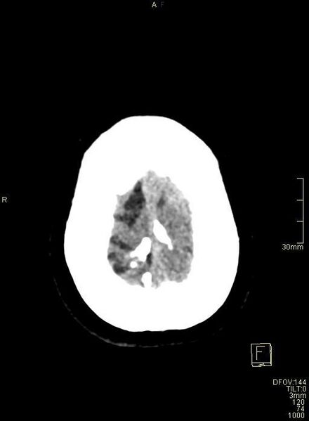 File:Cerebral venous sinus thrombosis (Radiopaedia 91329-108965 Axial non-contrast 46).jpg