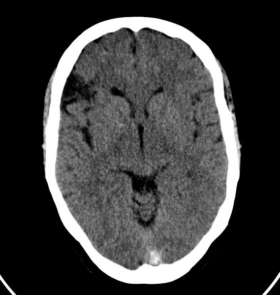 File:Cerebral venous thrombosis - CT only (Radiopaedia 41031-43778 Axial non-contrast 47).jpg