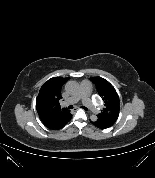File:Cervical aortic arch with coarctation and aneurysms (Radiopaedia 44035-47552 Axial non-contrast 21).jpg