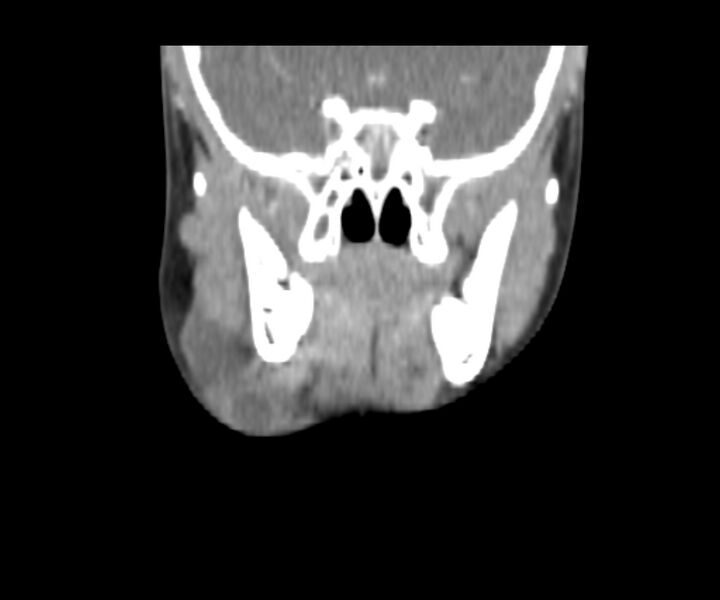 File:Cervical cystic lymphangioma (Radiopaedia 63655-72332 Coronal + contrast 15).jpg
