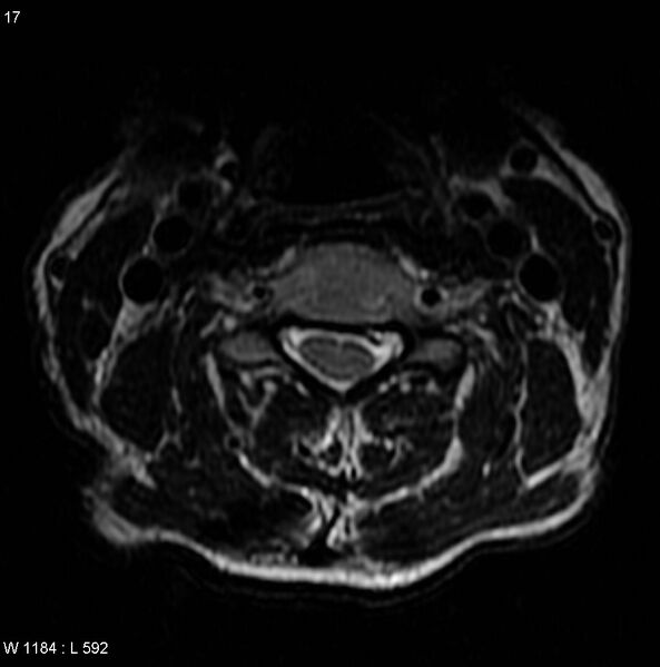File:Cervical disc extrusion (Radiopaedia 5216-6982 Axial T2 1).jpg