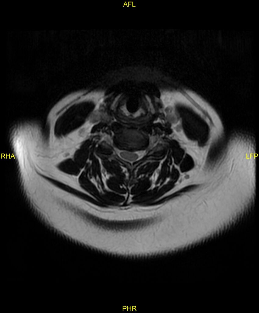 Cervical disc protrusion (Radiopaedia 87147-103415 Axial T2 21).jpg