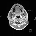 Cervical dural CSF leak on MRI and CT treated by blood patch (Radiopaedia 49748-54995 Axial T1 C+ 3).jpg