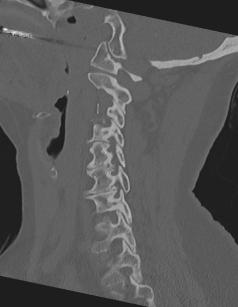 File:Cervical spine ACDF loosening (Radiopaedia 48998-54071 Sagittal bone window 34).png