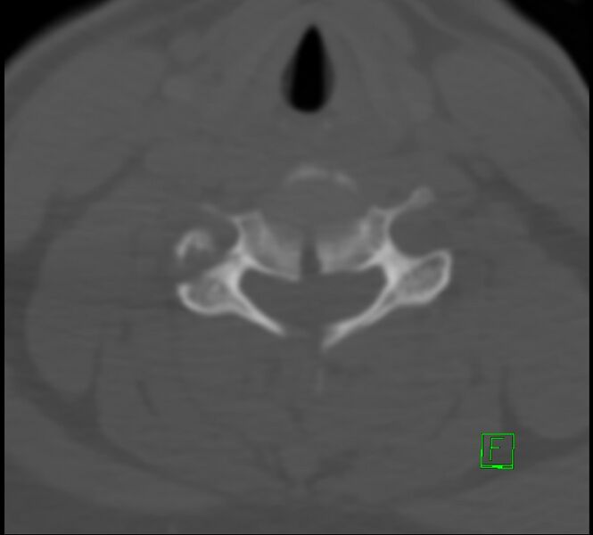 File:Cervical spine fracture - hyperflexion injury (Radiopaedia 66184-75364 Axial bone window 28).jpg