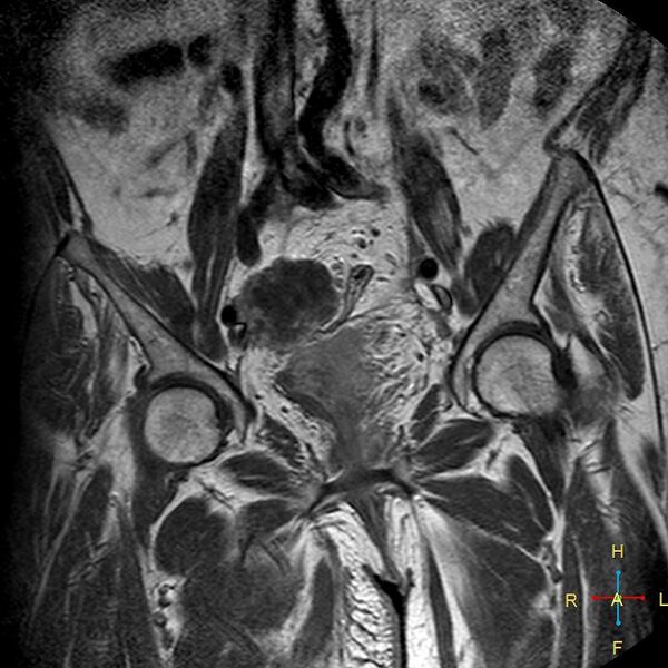 File:Cervical stump squamous cell carcinoma (Radiopaedia 48049-52858 Coronal T1 C+ 5).jpg