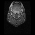Cervical vertebrae metastasis (Radiopaedia 78814-91667 Axial T1 C+ fat sat 2).png