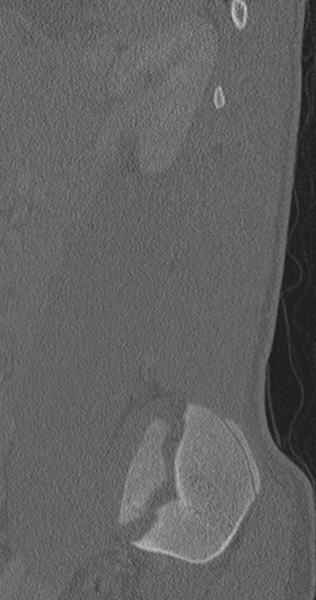 File:Chance fracture (Radiopaedia 40360-42912 Sagittal bone window 20).png