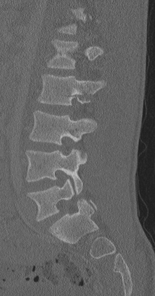 File:Chance fracture (Radiopaedia 40360-42912 Sagittal bone window 39).png