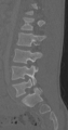 Chance fracture (Radiopaedia 40360-42912 Sagittal bone window 39).png