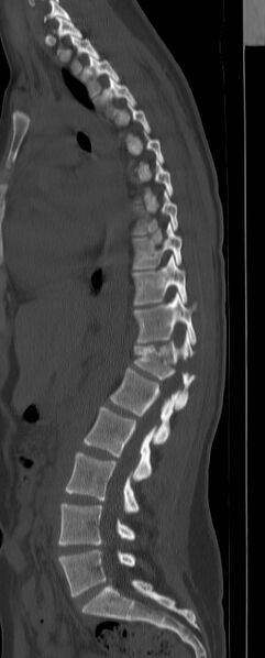 File:Chance fracture (Radiopaedia 45345-49372 Sagittal bone window 15).jpg