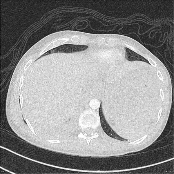 File:Chest and abdomen multi-trauma (Radiopaedia 26294-26425 lung window 87).jpg