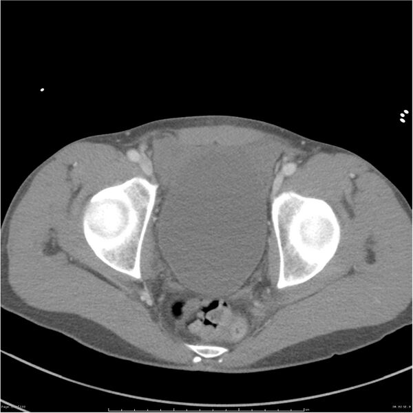 File:Chest and abdomen multi-trauma (Radiopaedia 26294-26426 bone window 80).jpg