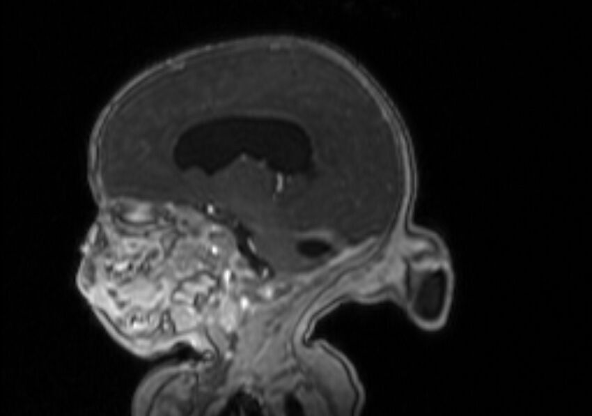 Chiari III malformation with occipital encephalocele (Radiopaedia 79446-92559 Sagittal T1 C+ mpr 41).jpg