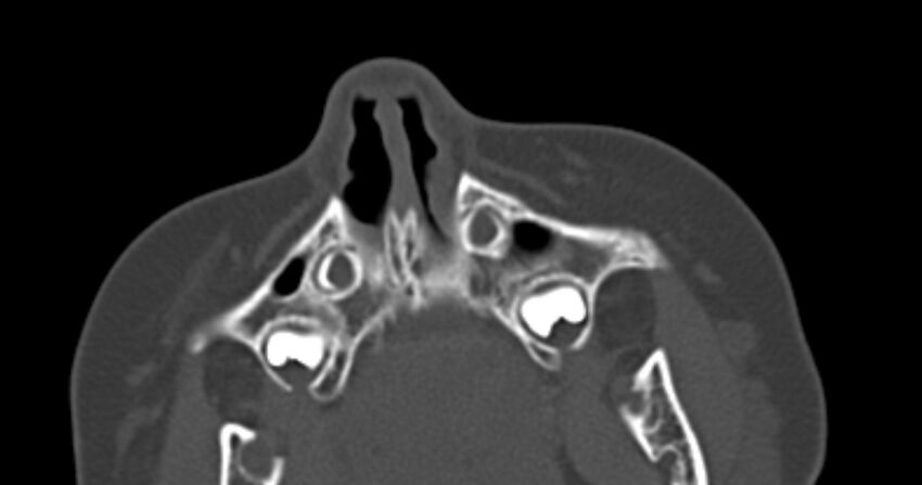 Choanal atresia (Radiopaedia 51295-56972 Axial bone window 8).jpg