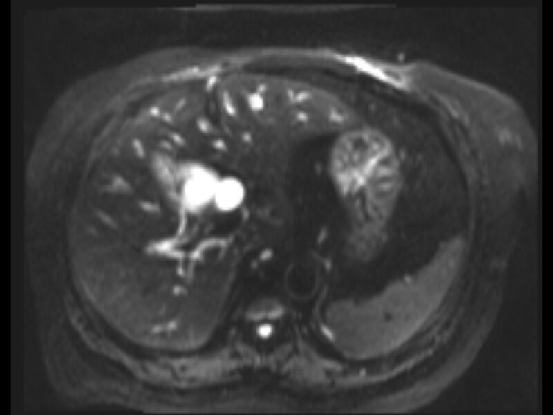 File:Choledocholithiasis causing intrahepatic biliary duct dilation (Radiopaedia 39908-42369 Axial T2 SPAIR 22).jpg