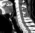 Chondrosarcoma - larynx (Radiopaedia 4588-6698 C 8).jpg