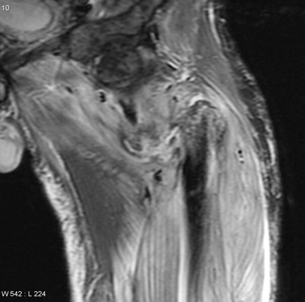 File:Chondrosarcoma with pathological fracture - femur (Radiopaedia 6174-7629 Coronal STIR 1).jpg