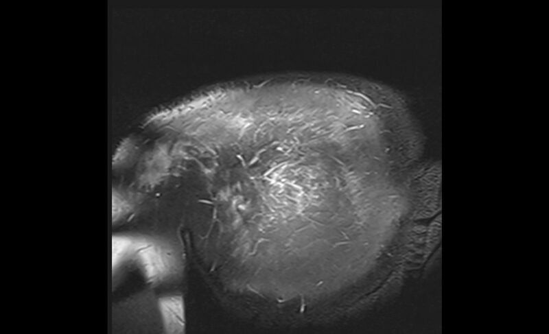 File:Choriocarcinoma in the shoulder (Radiopaedia 28603-28861 Coronal PD FS 31).jpg